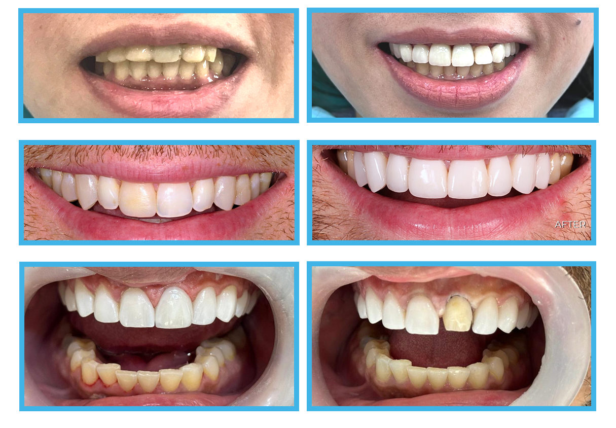 2 veneers before and after